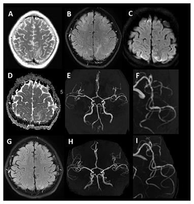 Cerebrovascular Disease in the Setting of Posterior Reversible Encephalopathy Syndrome